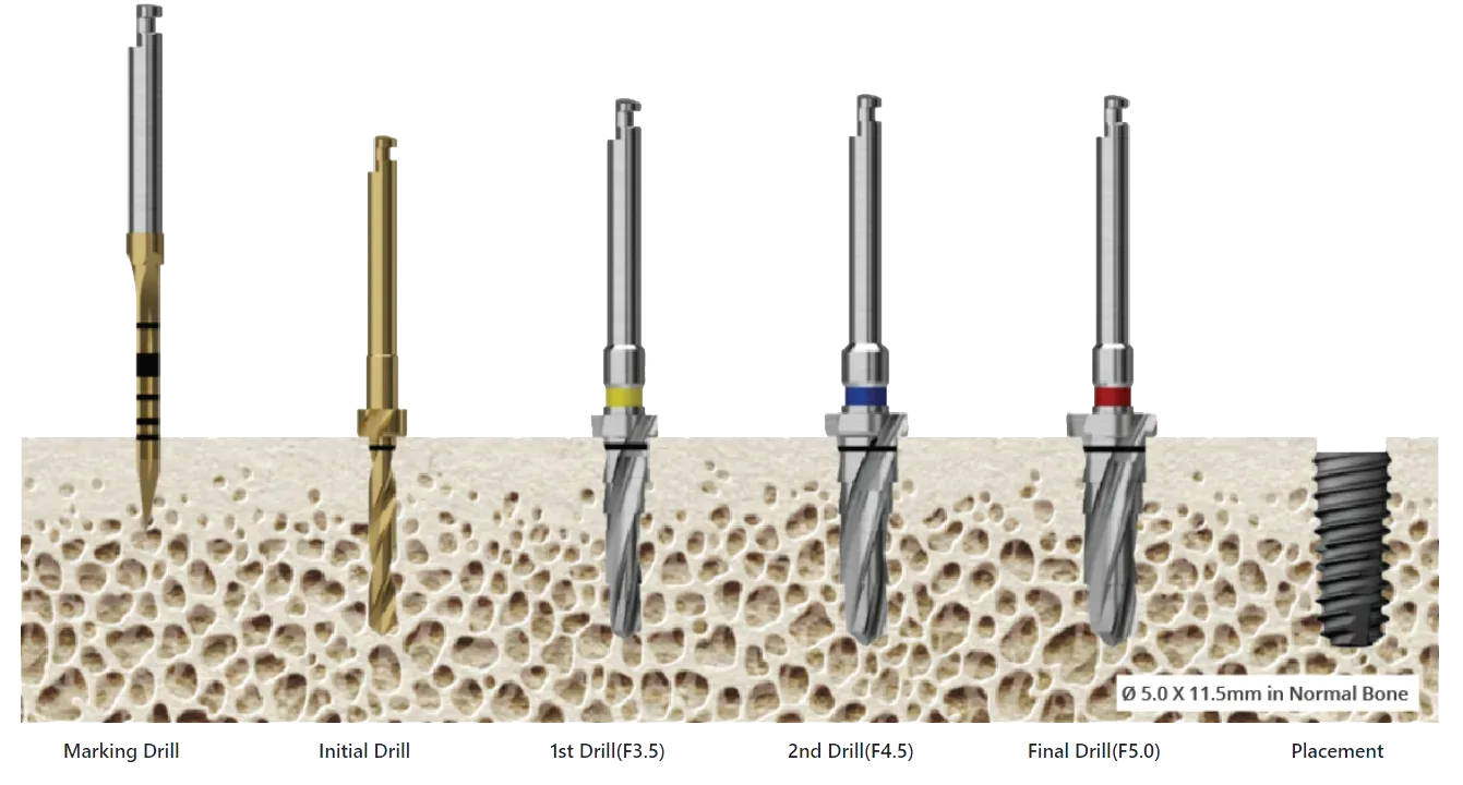implant osstem ts3 - hình 3