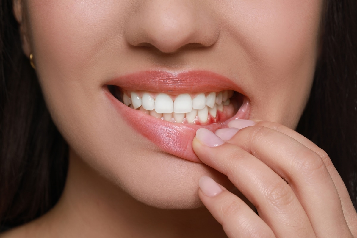 lành thương sau cấy implant - hình 3
