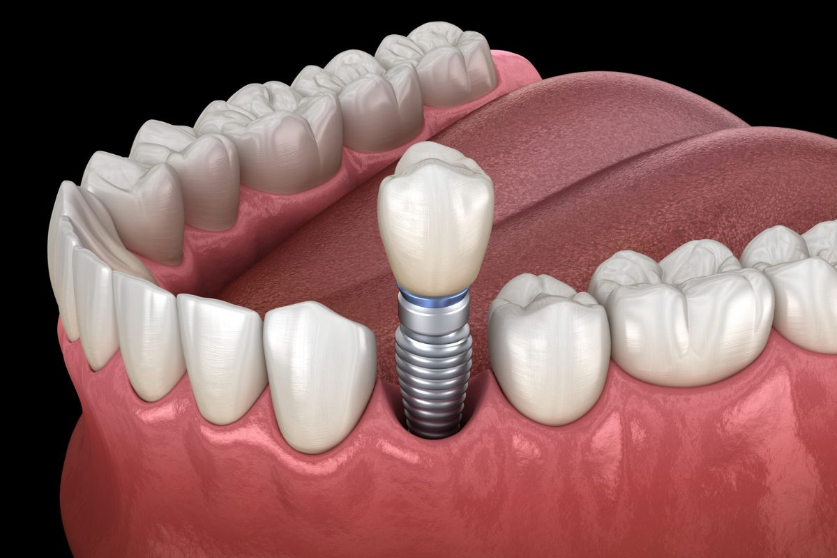 Mất 1 răng có nên trồng Implant ngay 2026