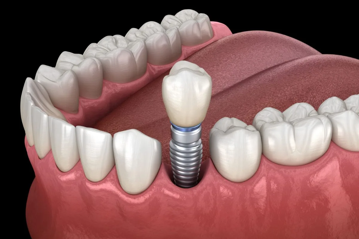 Mất 1 răng có nên trồng Implant ngay 2026