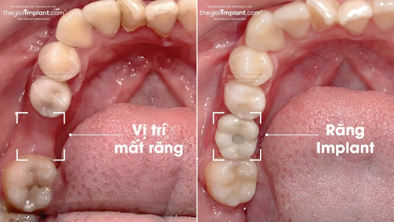 mất 1 răng trồng implant - hình 3