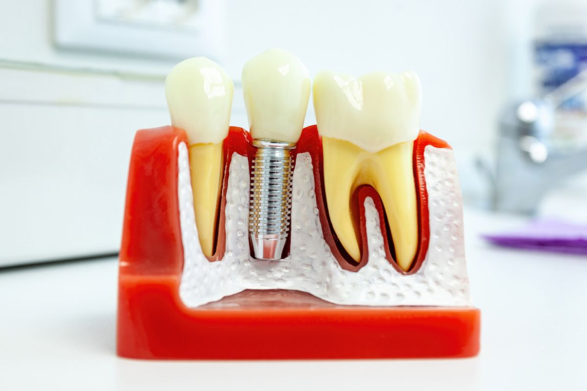 Peri-implantitis: nguyên nhân & phòng ngừa 2026