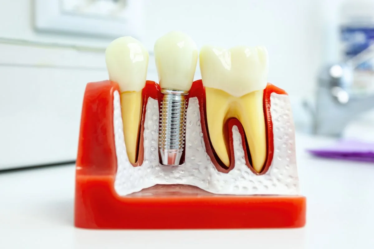 Peri-implantitis: nguyên nhân & phòng ngừa 2026