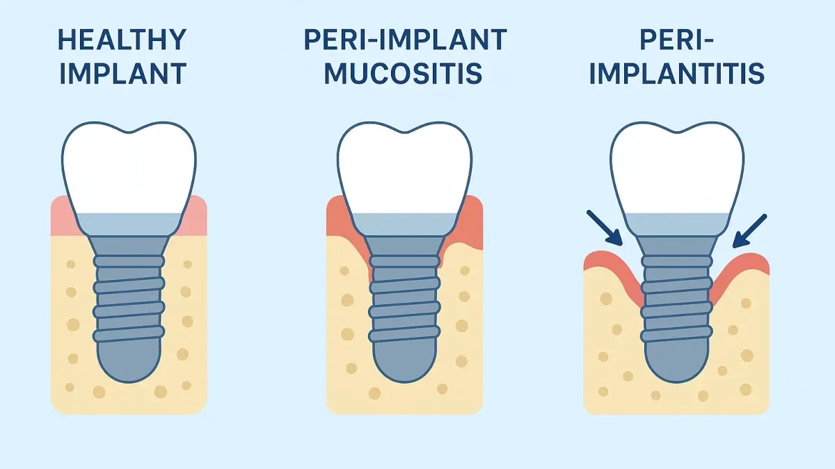 peri implantitis - hình 2