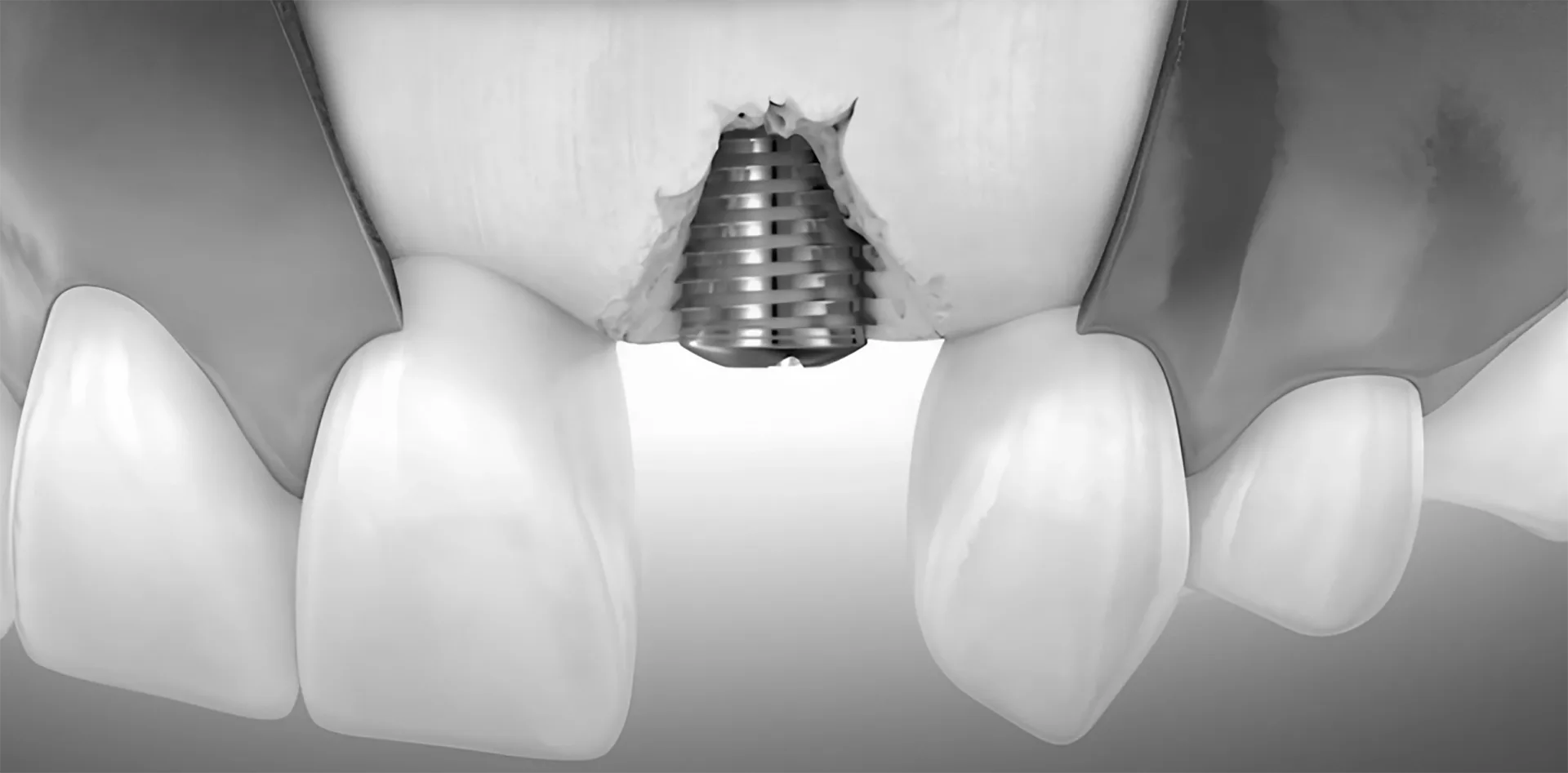 peri implantitis - hình 3