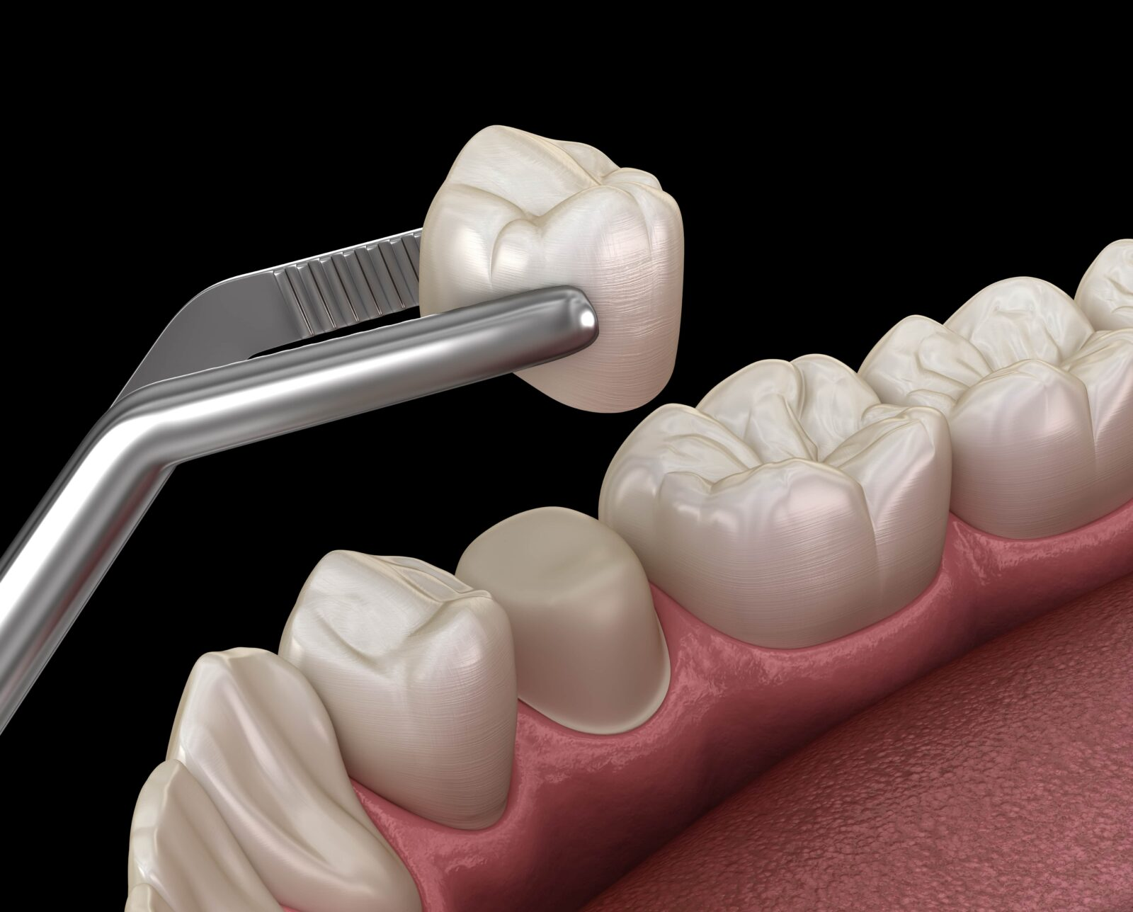 răng tạm trên implant - hình 2