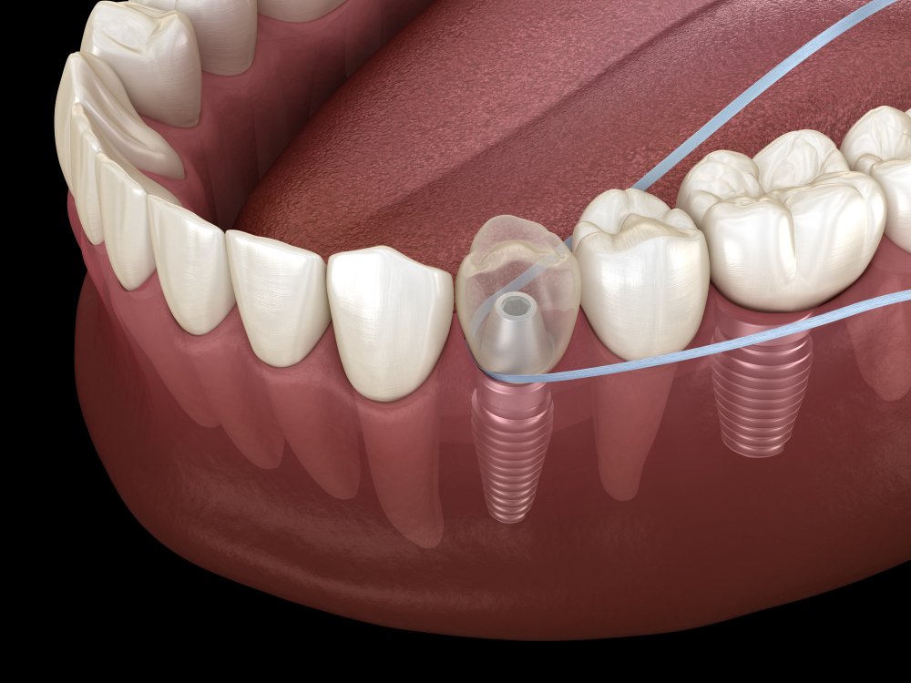 Vệ sinh Implant trọn đời: 5 bước 2026