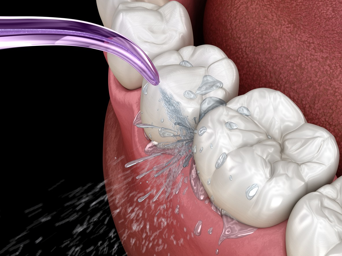 vệ sinh implant trọn đời - hình 4