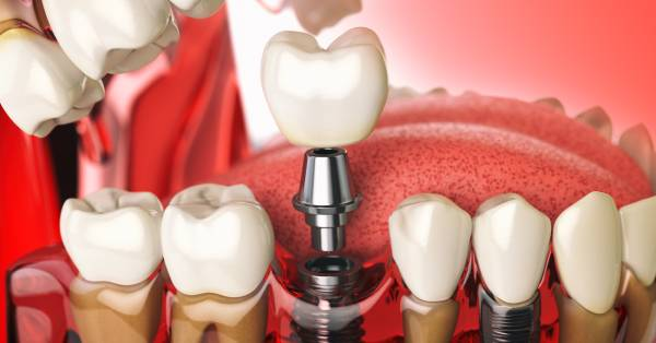 ăn gì tăng tốc implant - hình 2
