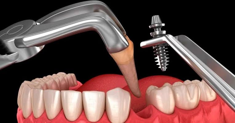 Bao lâu tích hợp xương Implant hoàn tất 2026