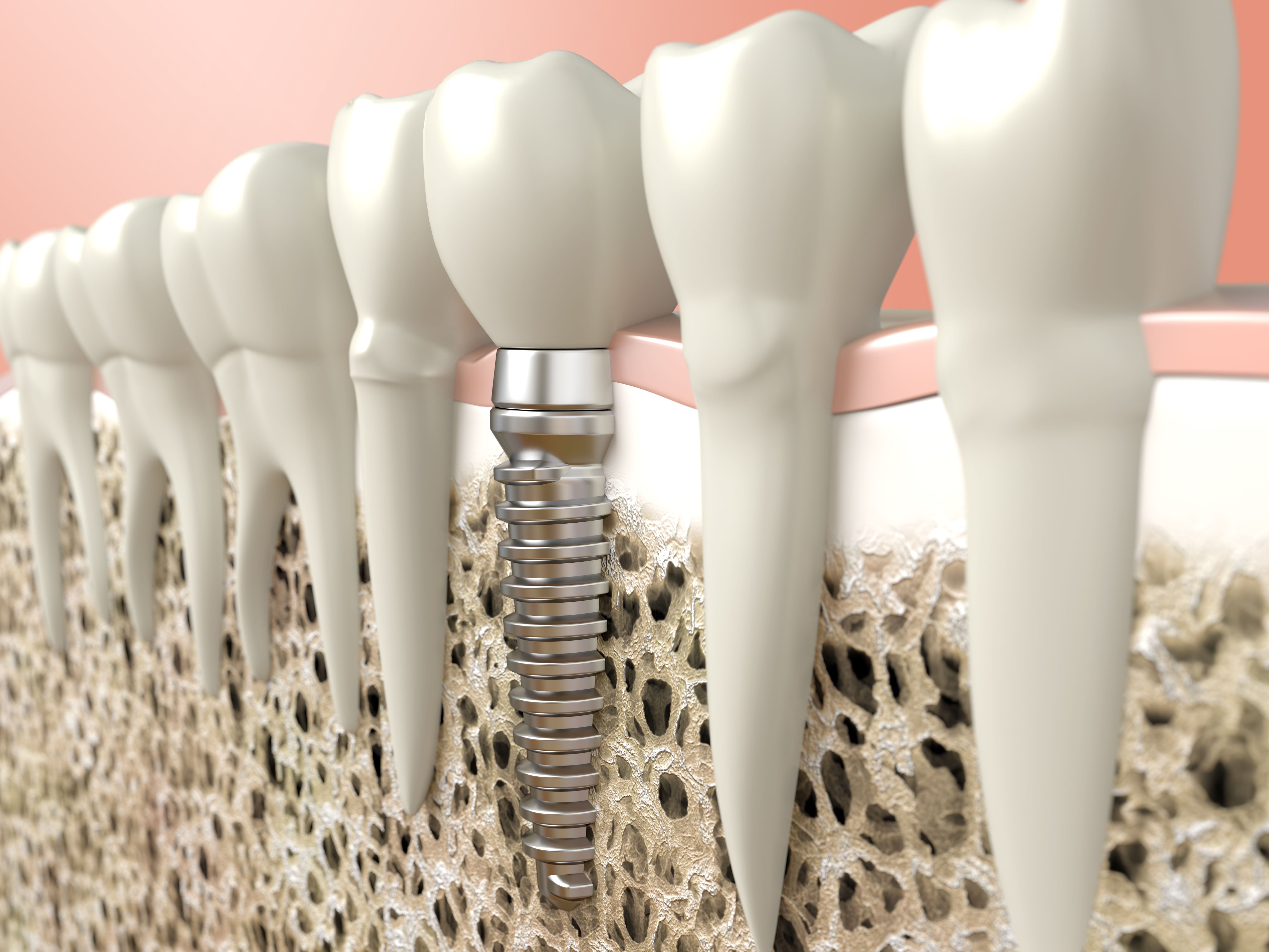 Bao lâu tích hợp xương Implant hoàn tất 2026