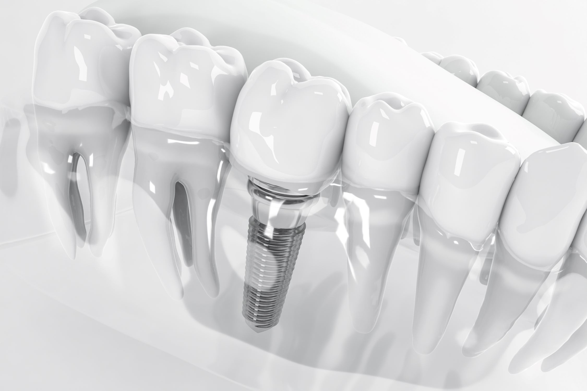 bay máy bay sau implant - hình 3