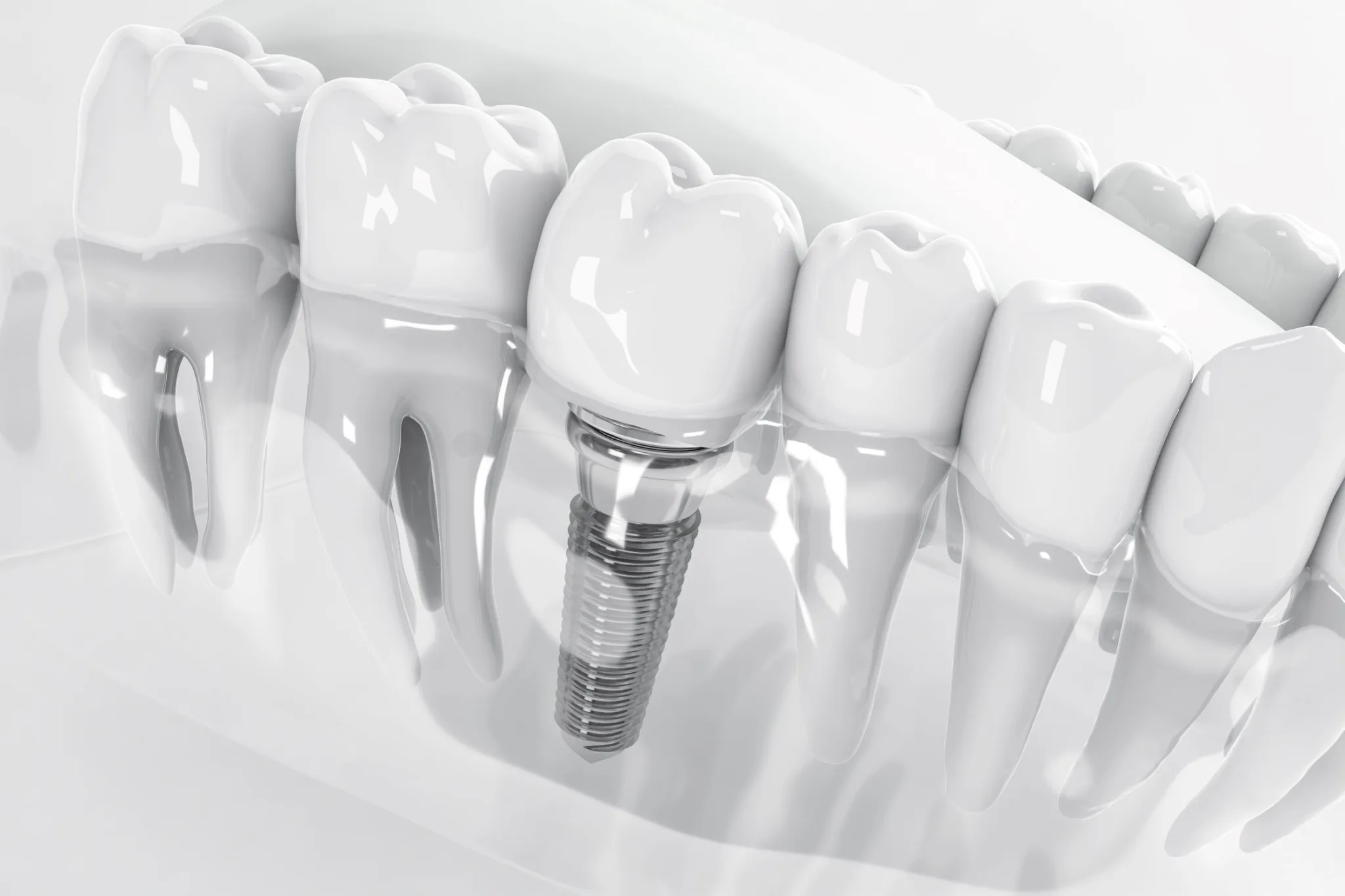 bay máy bay sau implant - hình 3