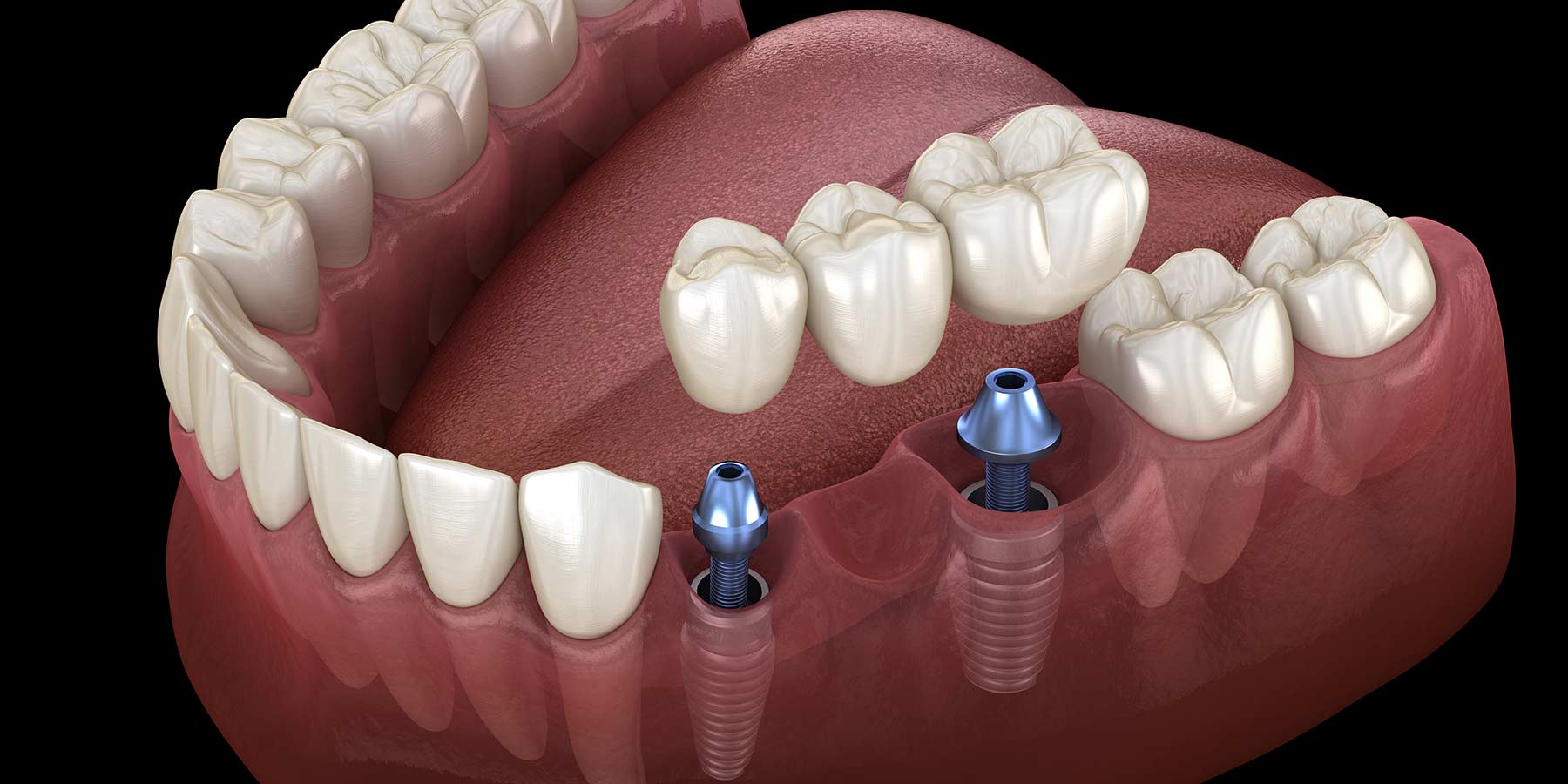 Cầu răng trên Implant (Implant bridge) 2026