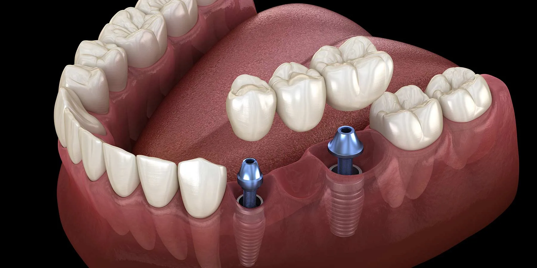 Cầu răng trên Implant (Implant bridge) 2026