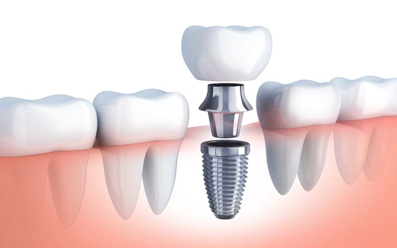 cầu răng trên implant - hình 2