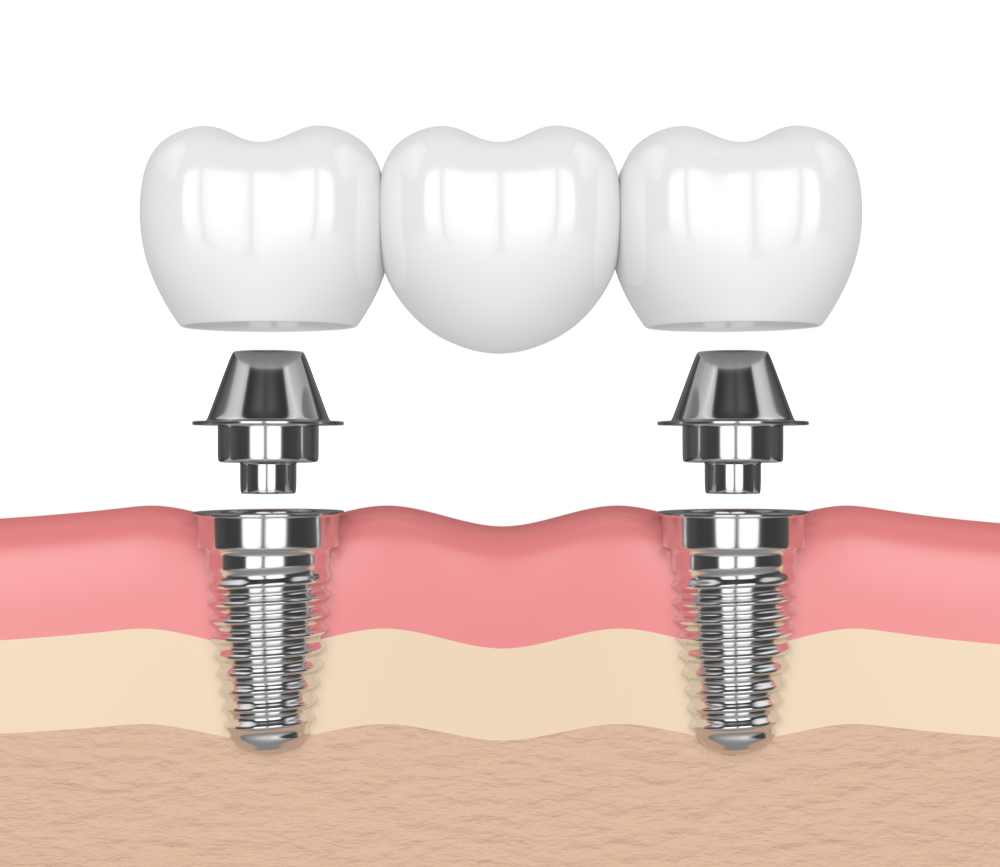 cầu răng trên implant - hình 3