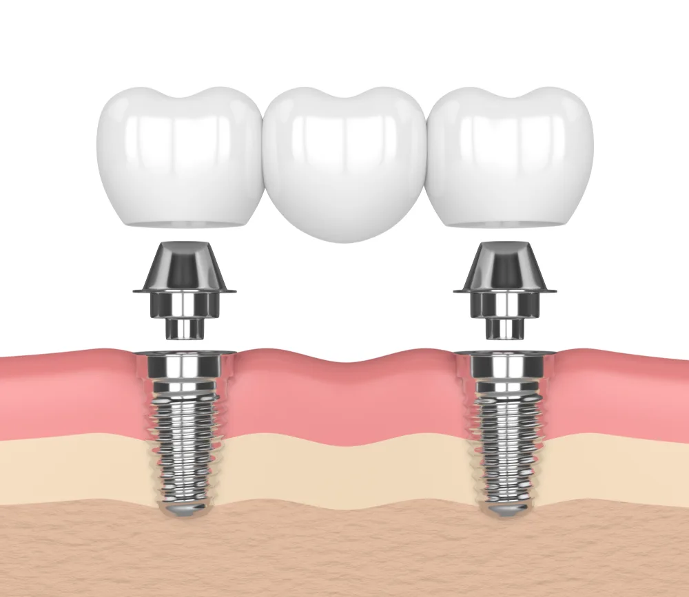 cầu răng trên implant - hình 3