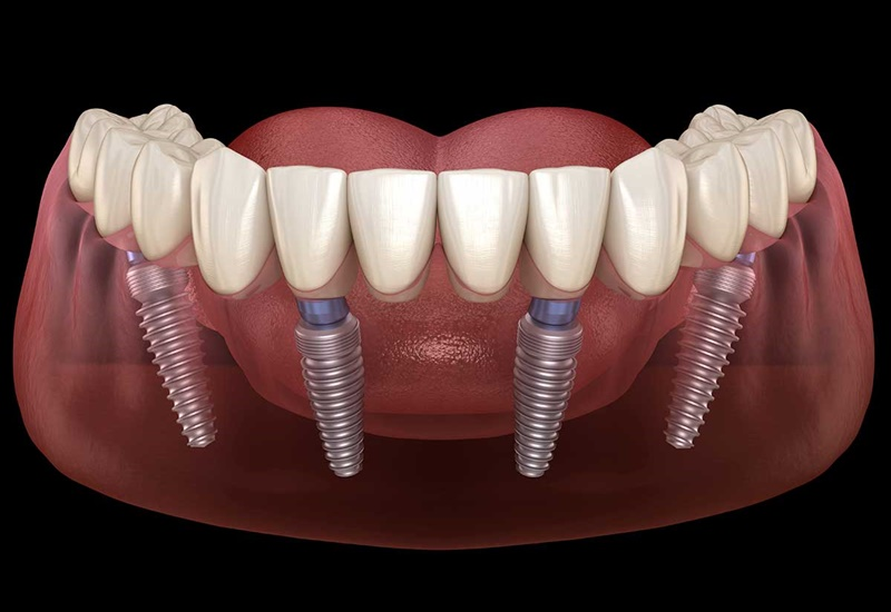 Chi phí Implant toàn hàm All-on-4/6 2026