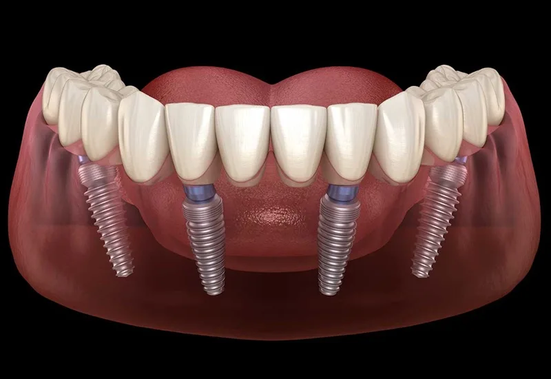 Chi phí Implant toàn hàm All-on-4/6 2026
