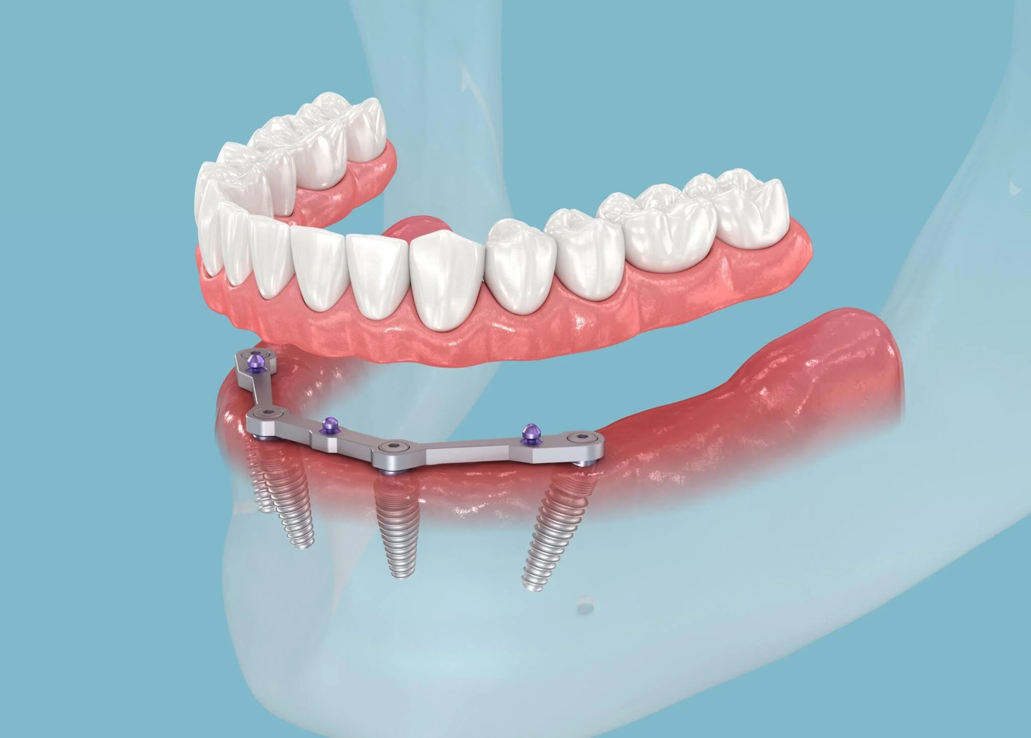 chi phí implant toàn hàm - hình 2