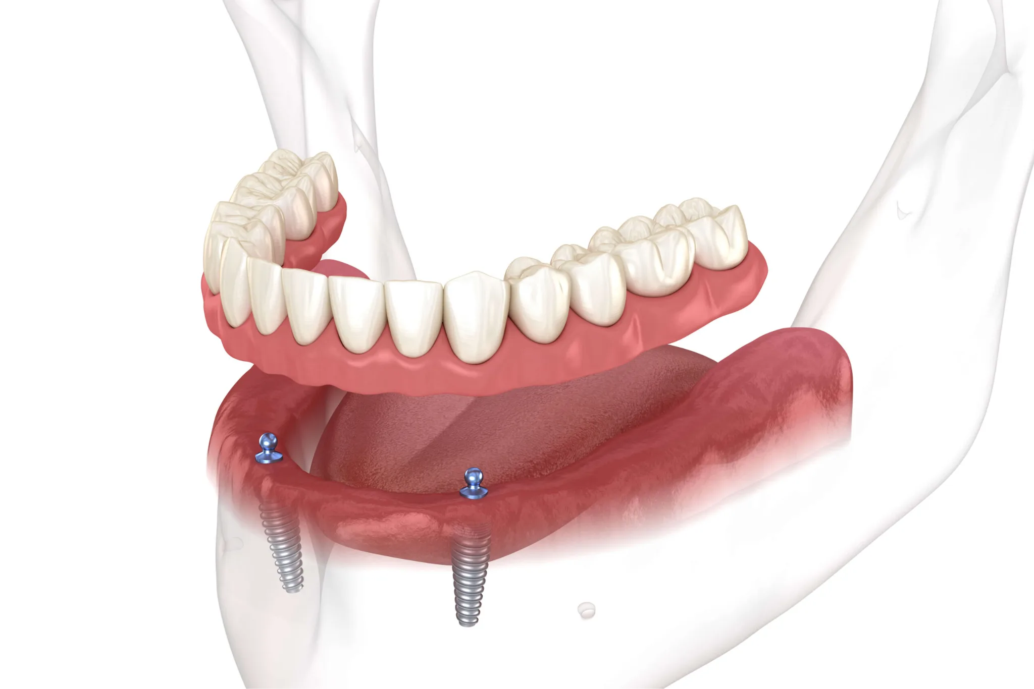 Hàm tháo lắp trên Implant overdenture 2026