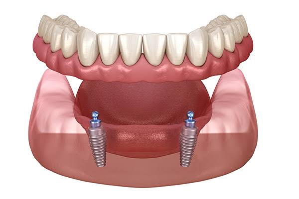 hàm tháo lắp trên implant - hình 2