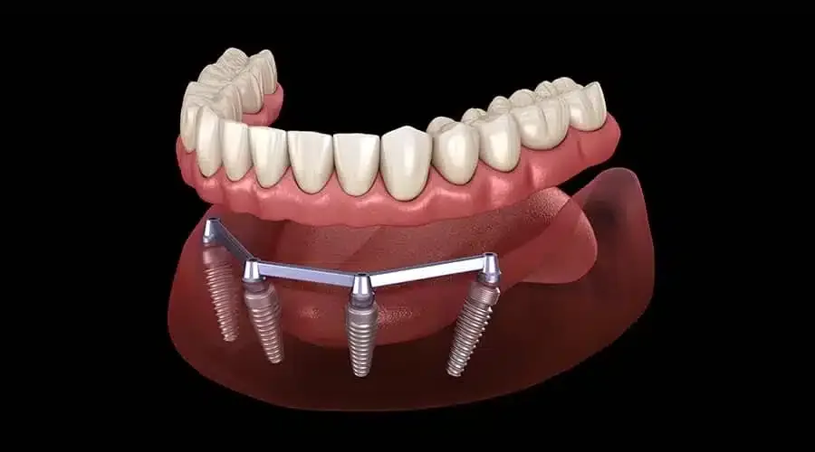 hàm tháo lắp trên implant - hình 3