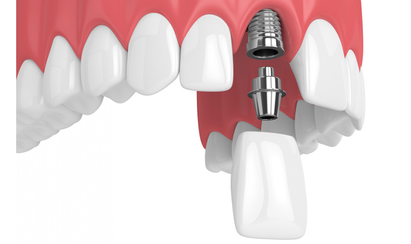 Implant cho răng cửa thẩm mỹ 2026