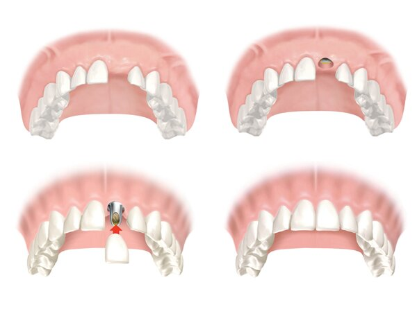 implant răng cửa thẩm mỹ - hình 2