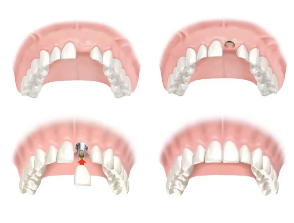 implant răng cửa thẩm mỹ - hình 2