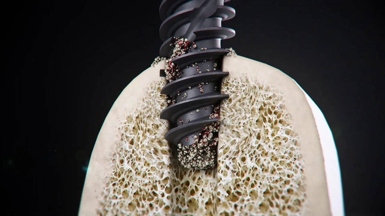 implant răng cửa thẩm mỹ - hình 3