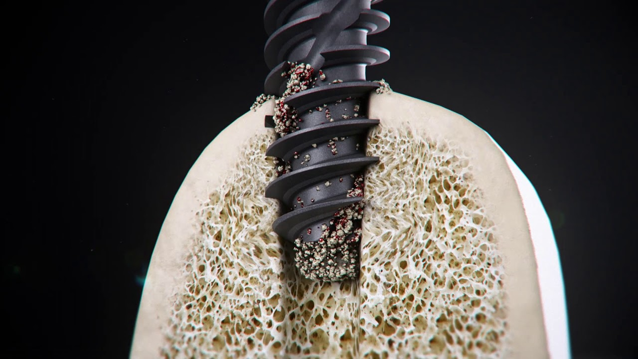 Implant Straumann BLX cao cấp: đặc điểm 2026