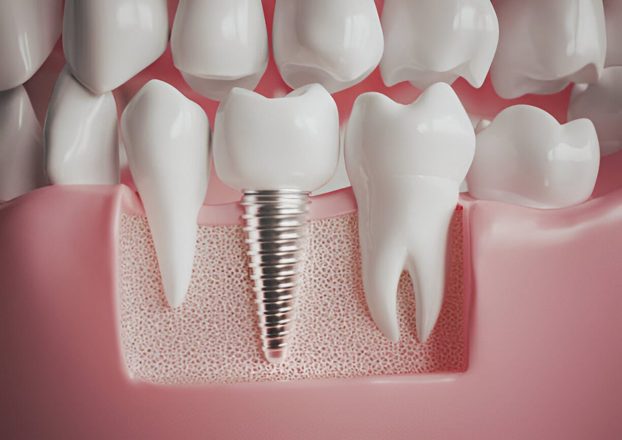 Implant tuổi thọ bao lâu: 20-30 năm 2026