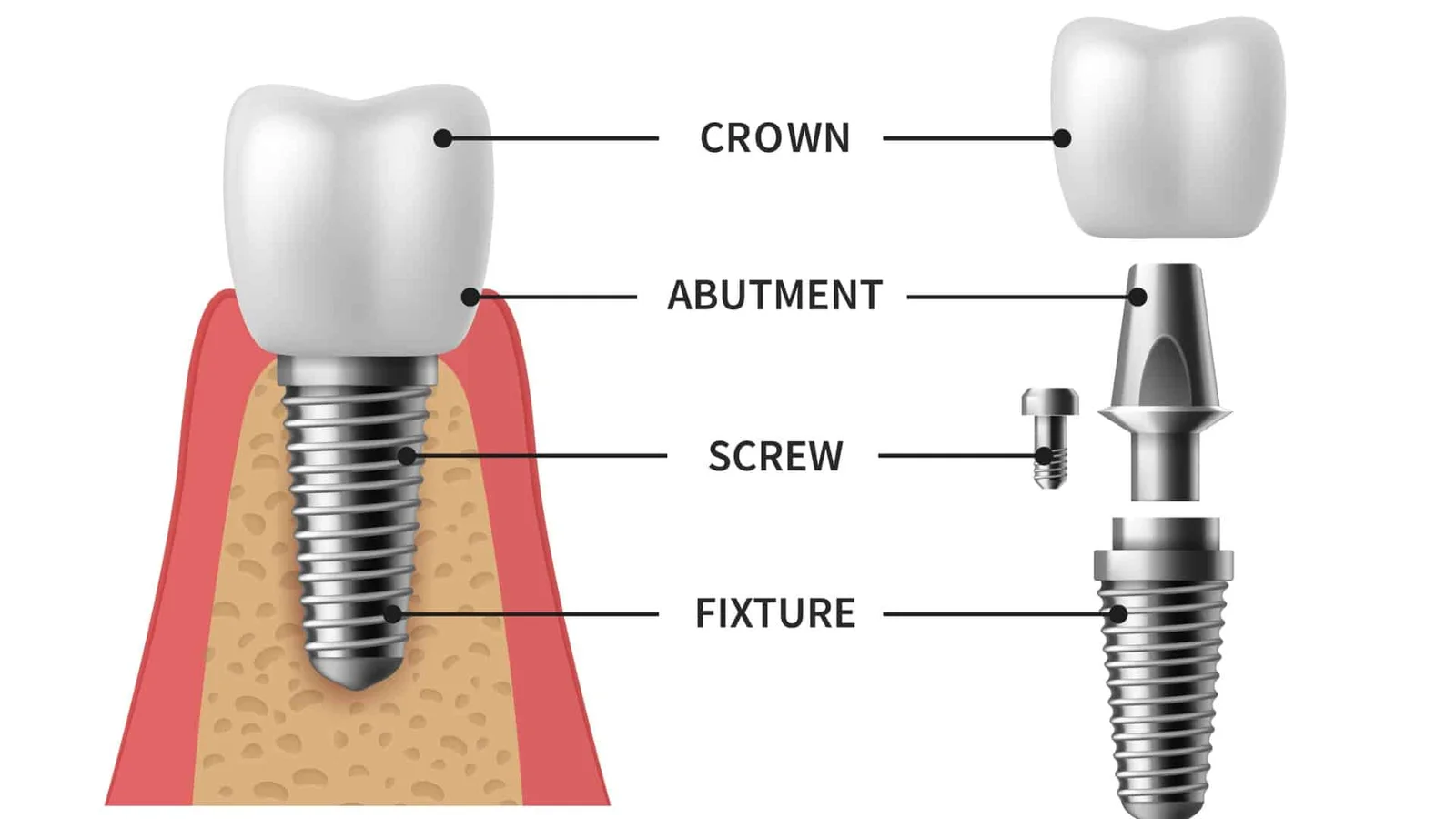 implant tuổi thọ bao lâu - hình 2