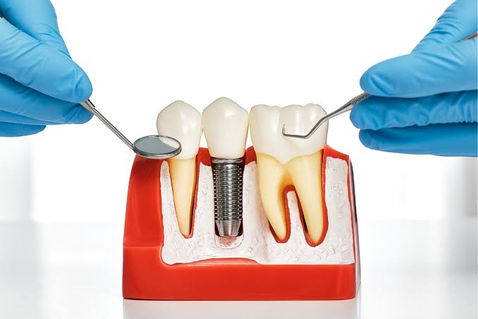 implant tuổi thọ bao lâu - hình 3