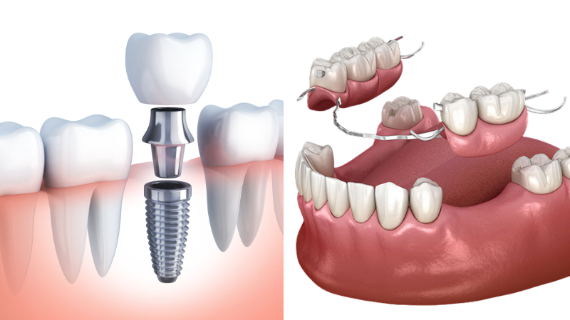 Implant vs hàm giả tháo lắp: chọn nào 2026