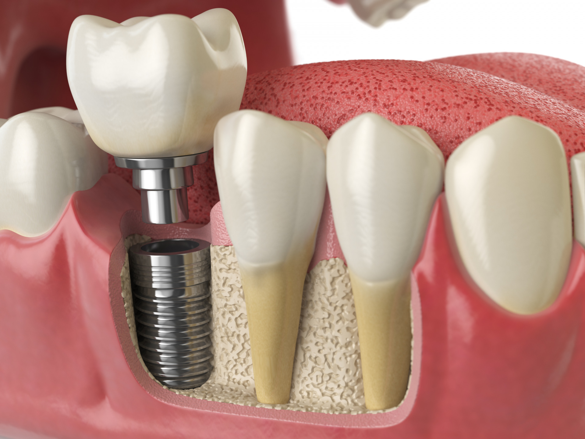 implant vs hàm tháo lắp - hình 2