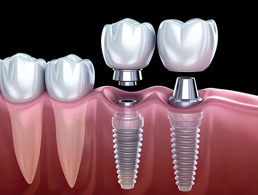 implant vs hàm tháo lắp - hình 3