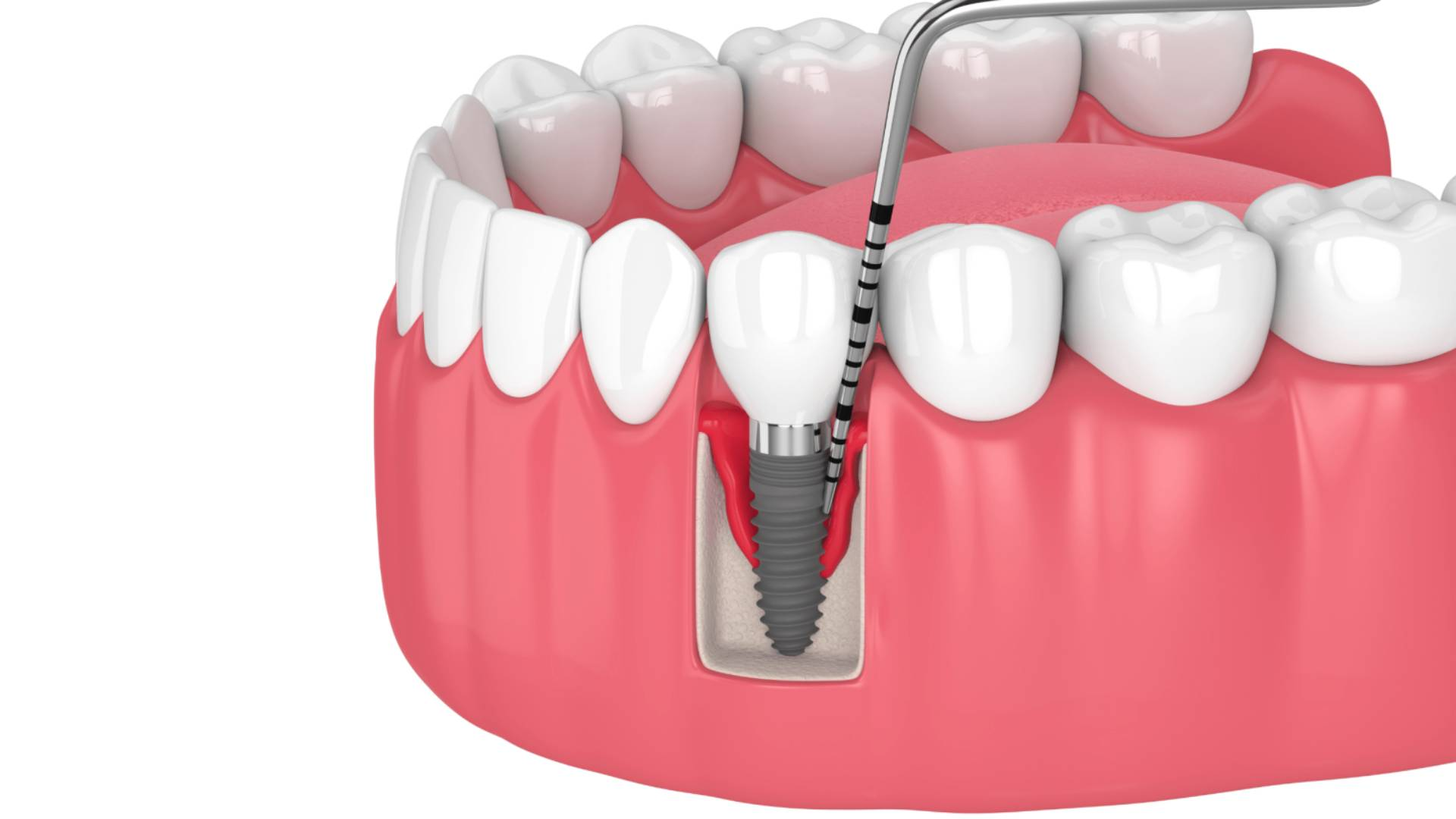 Bao lâu nhổ răng cấy Implant được 2026