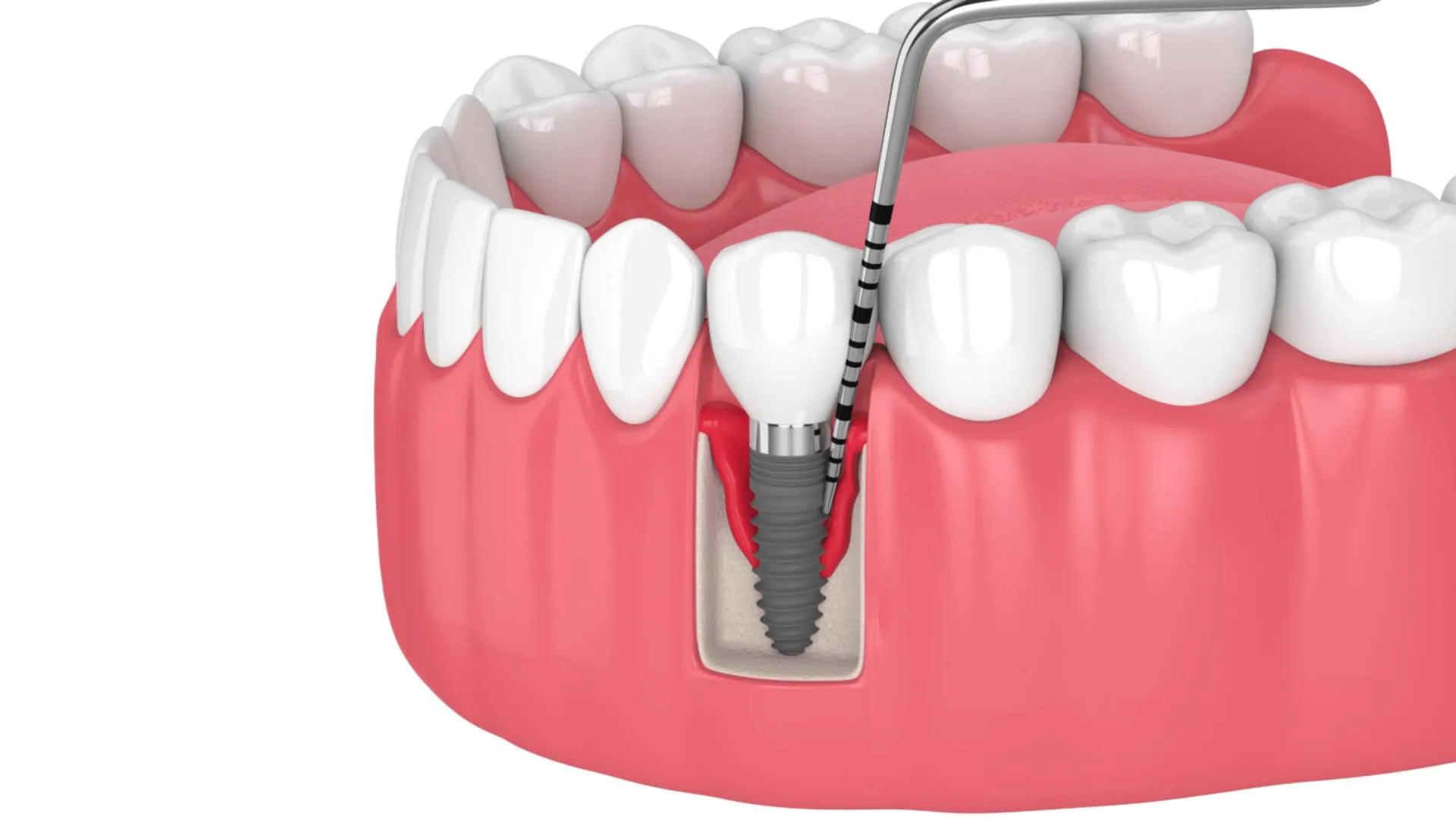 Bao lâu nhổ răng cấy Implant được 2026
