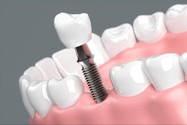 sau nhổ răng cấy implant - hình 3