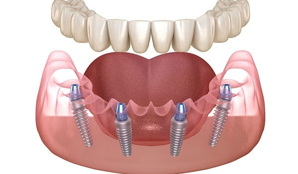 bảng giá implant 09/2026 - hình 4