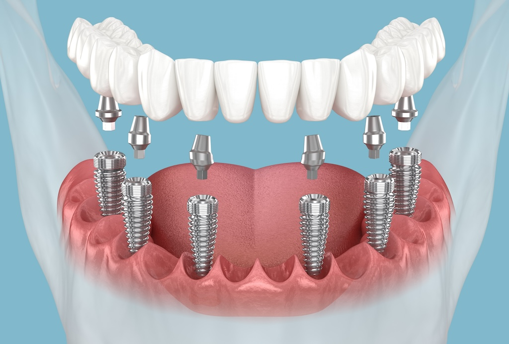bảng giá implant 09/2026 - hình 5