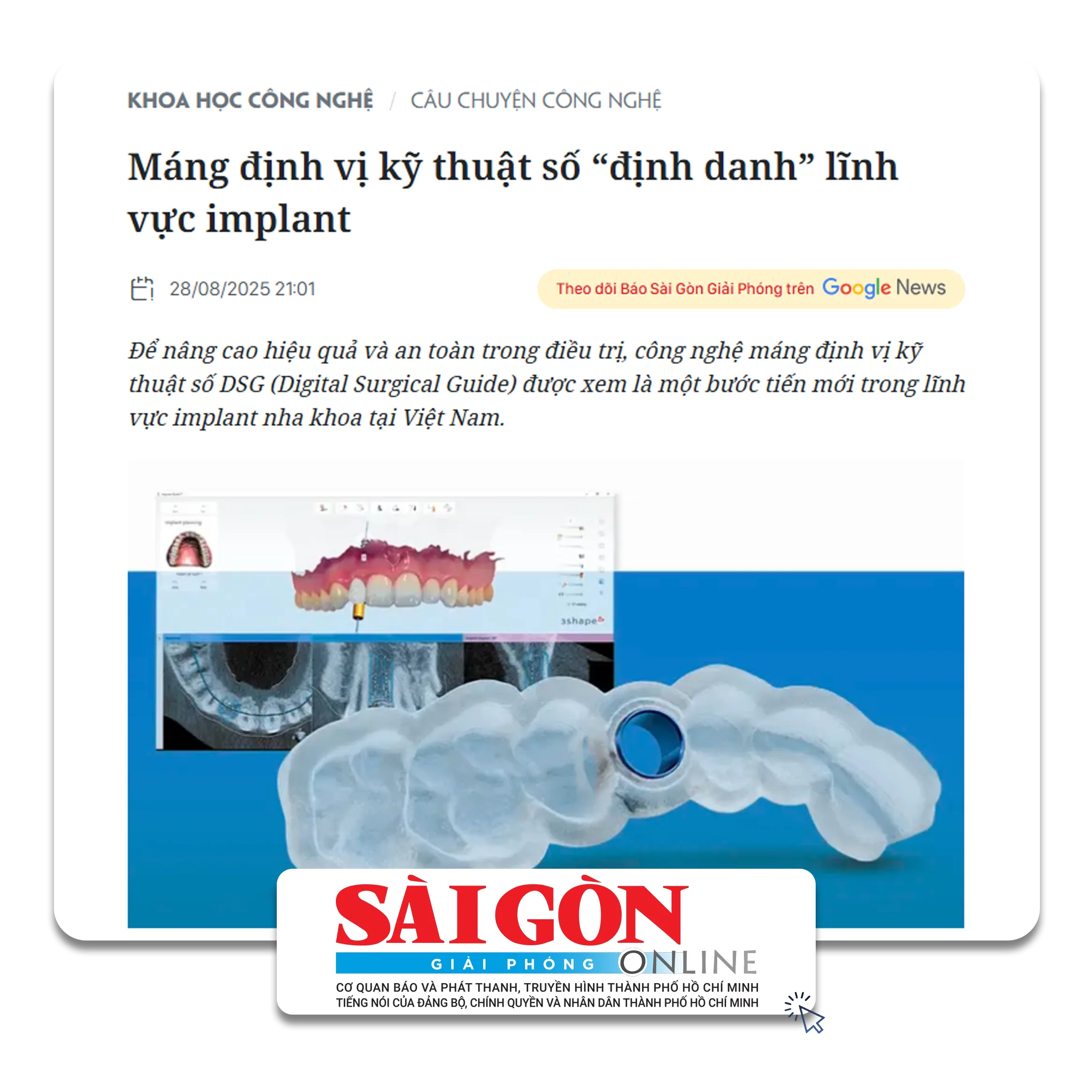 Báo Sài Gòn Giải Phóng viết về Thegioiimplant.com