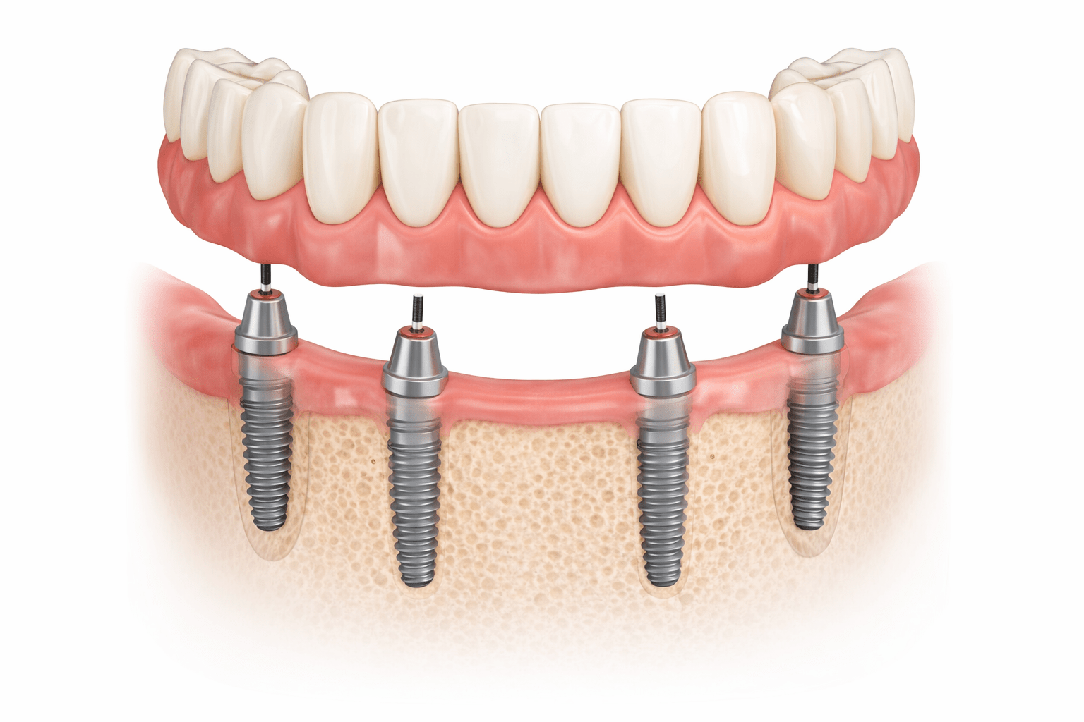 implant all-on-4 giá - hình 2