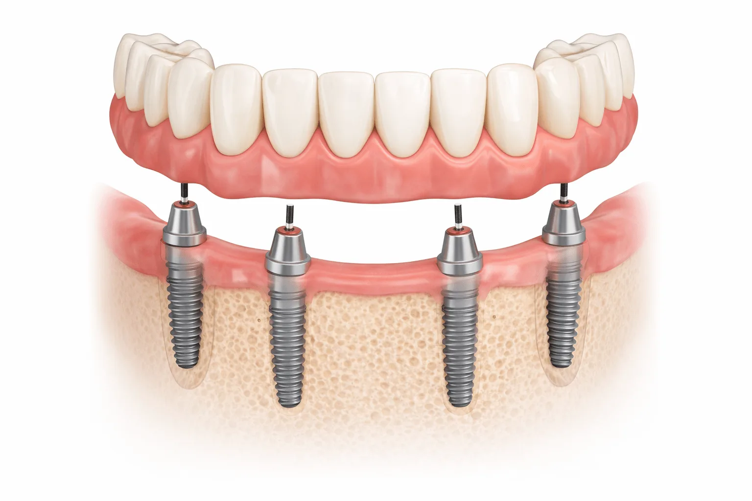 implant all-on-4 giá - hình 2
