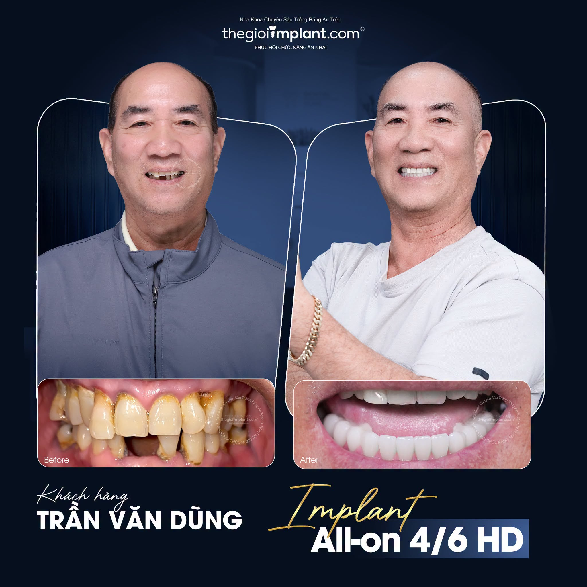 implant all-on-4 giá - hình 3