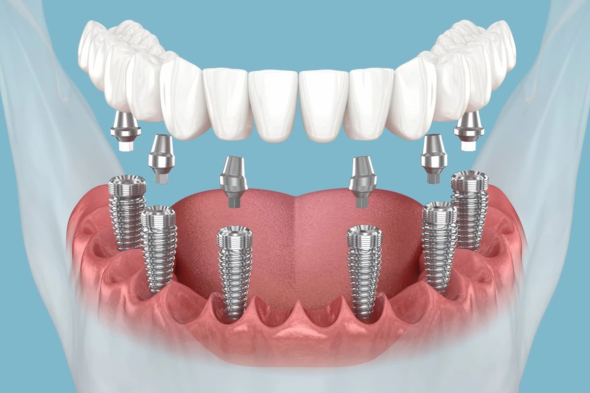 Implant All-on-6 giá bao nhiêu 2026: 213-308tr