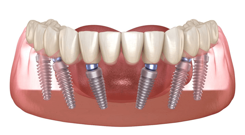 implant all-on-6 giá - hình 2